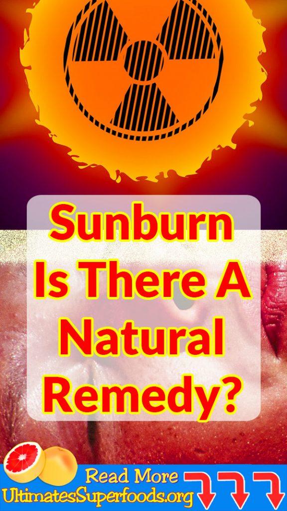 sunburn-what-can-i-do