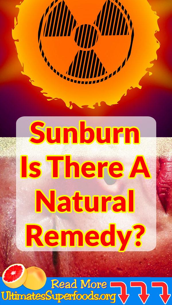 sunburn-what-can-i-do