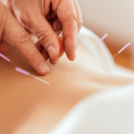Person receiving acupuncture treatment on their back.
